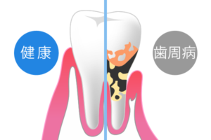 歯周病は「高齢者の病気」ではありません